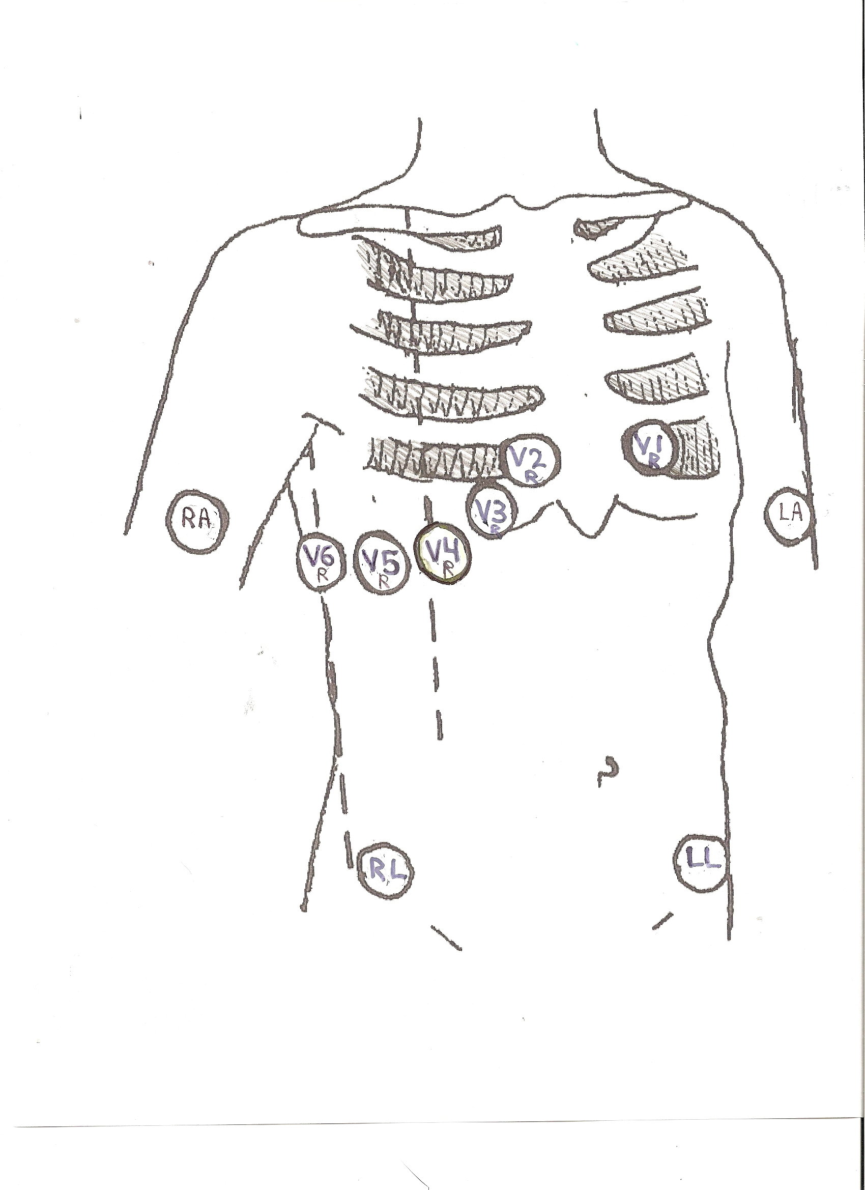 Right chest leads ECG Guru Instructor Resources